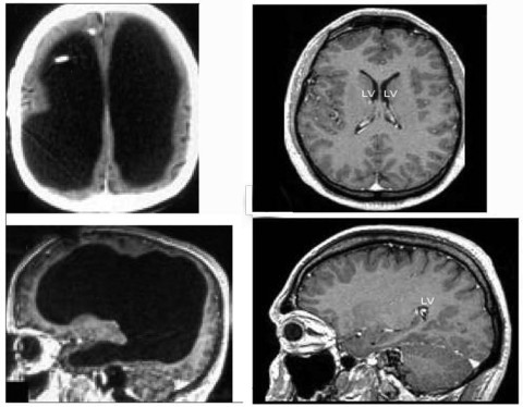 The large black space shows the fluid that replaced much of the patient’s brain (left). For comparison, the images (right) show a typical brain without any abnormalities. Photo: Feuillet et al., The Lancet