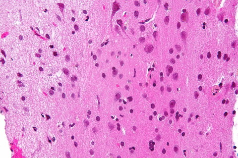 Micrograph showing grey matter, with the characteristic neuronal cell bodies (dark shade of pink), and white matter with its characteristic fine meshwork-like appearance (left of image, lighter shade of pink)